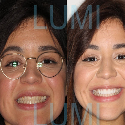 Lumi Dentite Teeth Repair